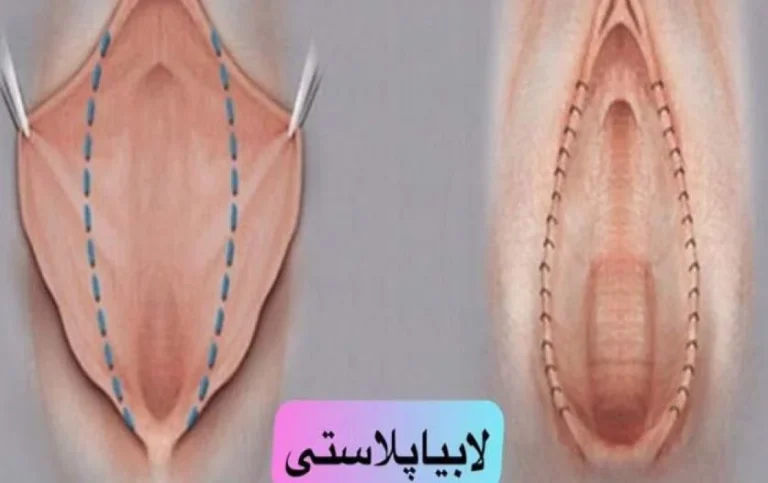 آیا عمل لابیاپلاستی درد دارد؟