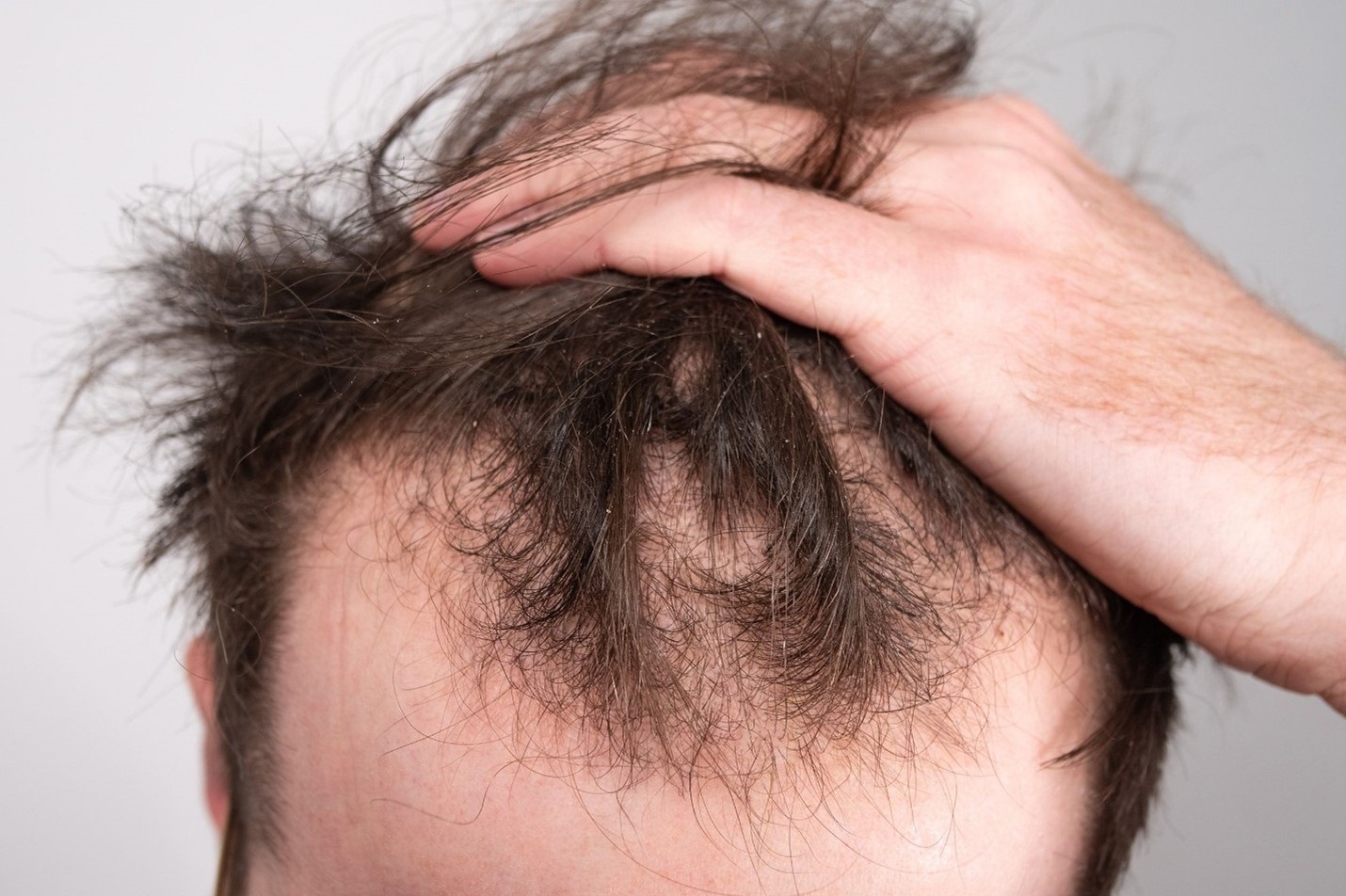 Behandeling van manlike haarverlies in tradisionele medisyne