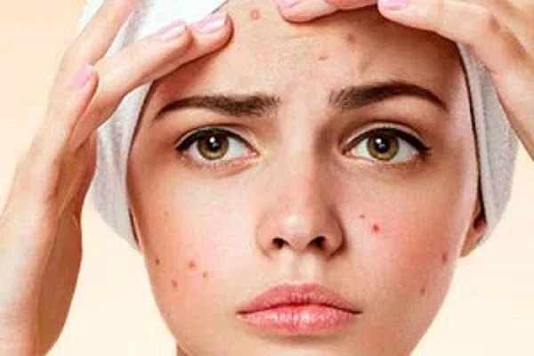 Cleaning acne skin at home