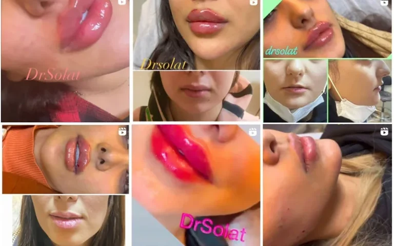 انواع مدل ژل لب را بشناسید
